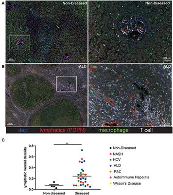 Chronic Liver Disease in Humans Causes Expansion and Differentiation of Liver Lymphatic Endothelial Cells